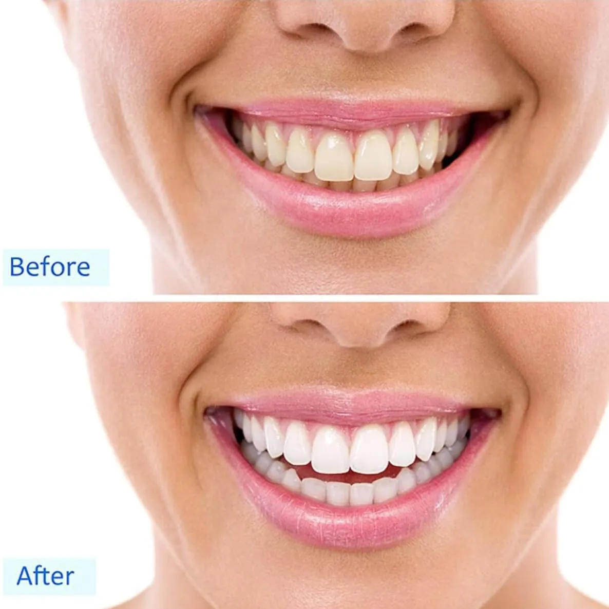 32 LED Teeth Whitening Accelerator Light with Cold Light &Red Lights Trays Device, Teeth Whitening Enhancer Light Built-in 16 Minute Timer (White) White