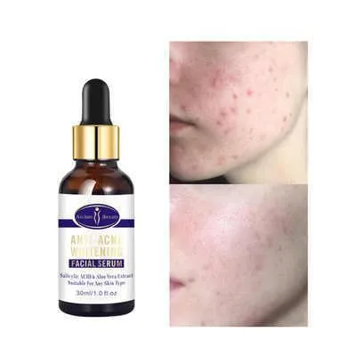 Anti-Acne Whitening Facial Serum 30ml - Aichun Beauty