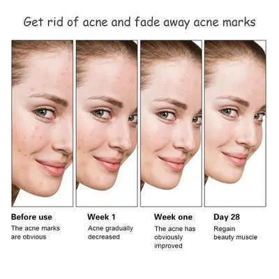 Anti-Acne Whitening Facial Serum 30ml - Aichun Beauty