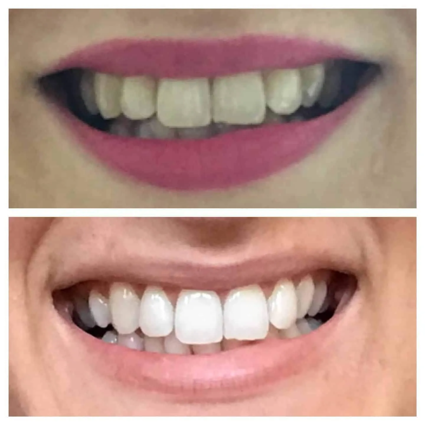 Home Teeth Whitening Kit (Just 10 minutes a day!)