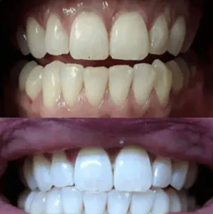 Home Teeth Whitening Kit (Just 10 minutes a day!)