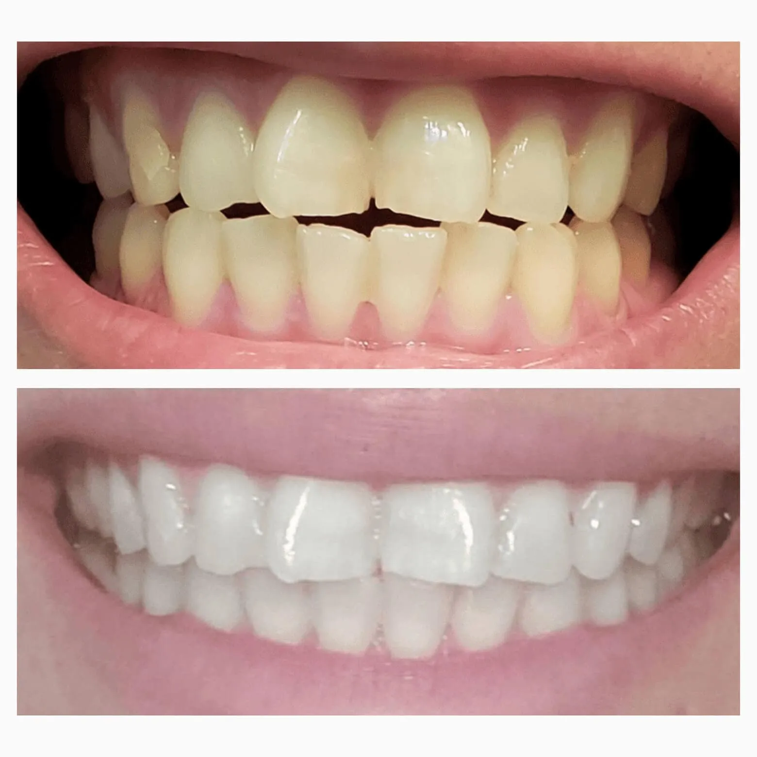 New Extra-Strength Teeth Whitening Serum