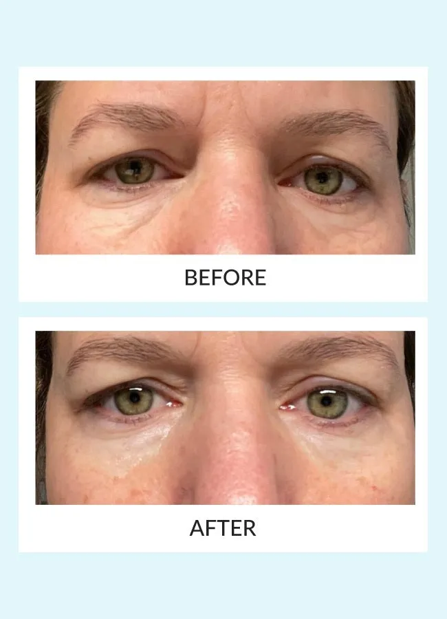 Reusable Eye Therapy Patches Refill