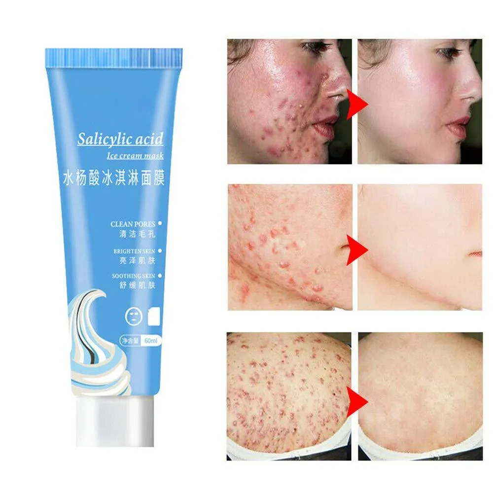 Salicylic Acid - Clear Skin Ice Cream Mask Gel (120 ML) - BUY 1 GET 1 FREE